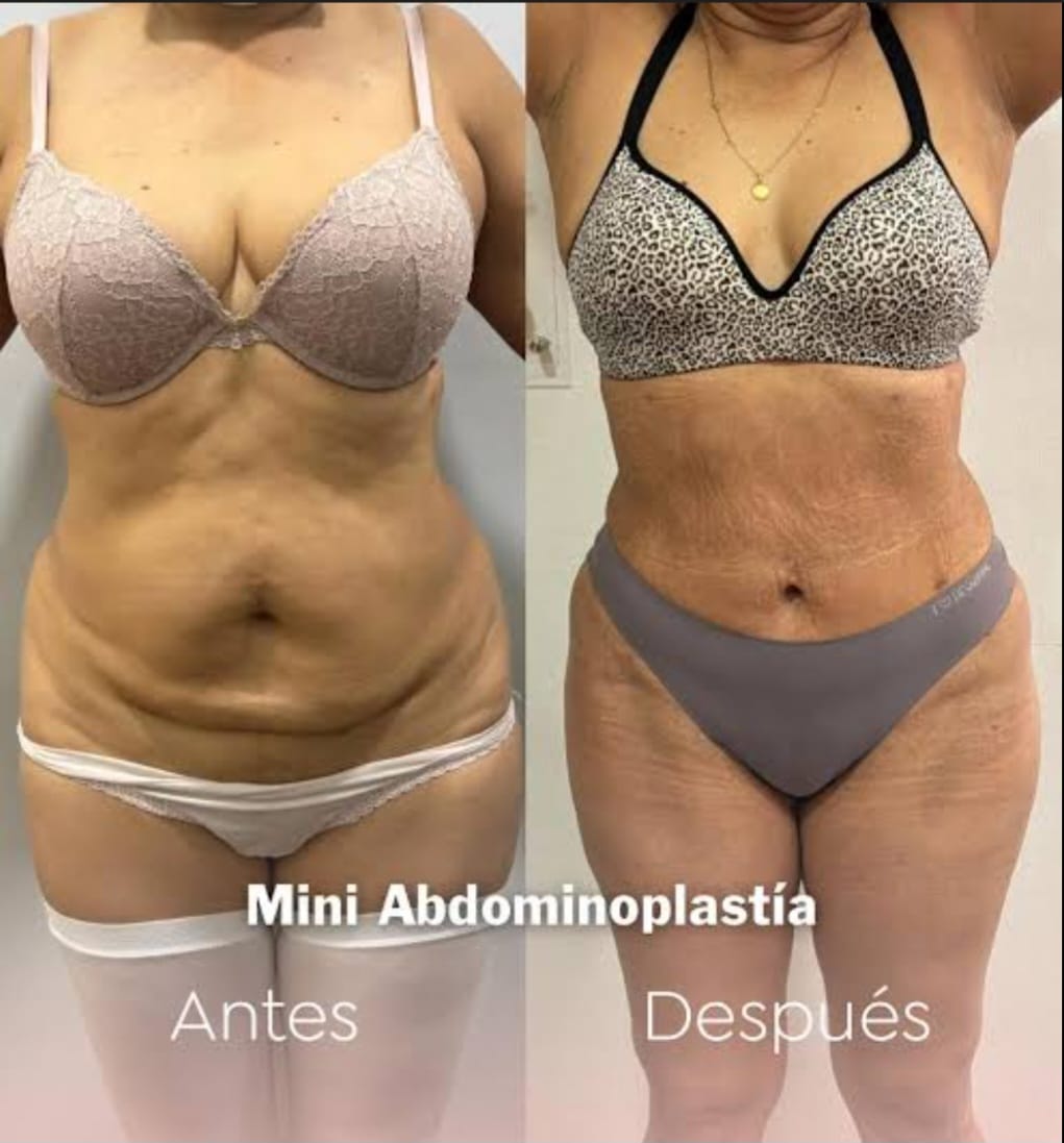 Resultado Miniabdominoplastia 3